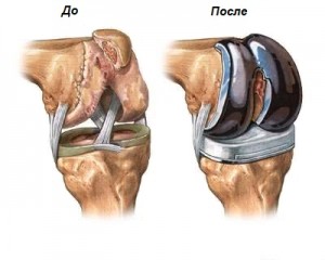 Суть осуществления эндопротезирования