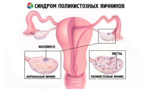 Синдром поликистозных яичников (спкя)