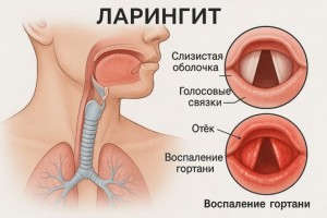Пропал голос при ларингите: эффективные методы лечения дисфонии и афонии