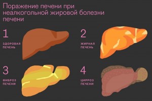 Что такое жировой стеатоз печени: причины, последствия и методы лечения