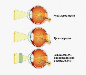 Почему падает острота зрения: формы рефракционных нарушений и лечение